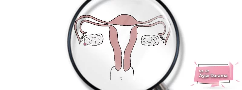 obstetri-ve-uterus-inversiyonu